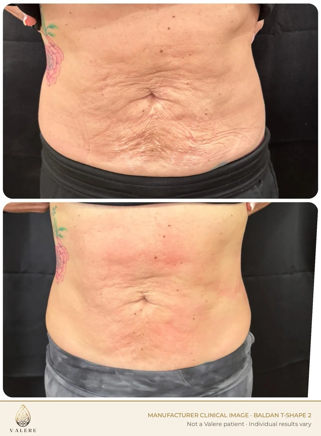 T-Shape 2 before and after, abdominal skin laxity, three sessions