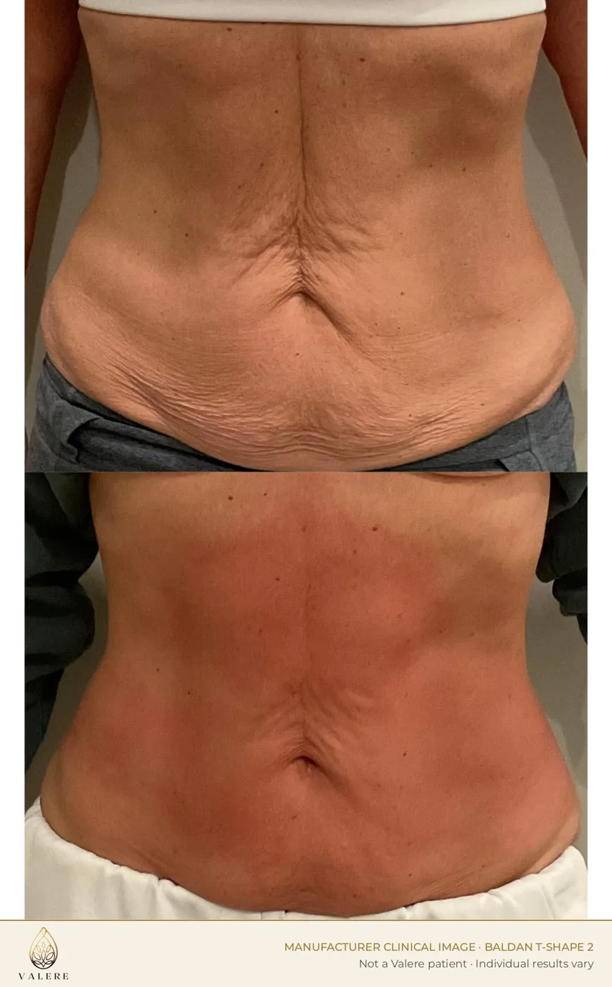 T-Shape 2 before and after, abdominal skin texture, two treatments