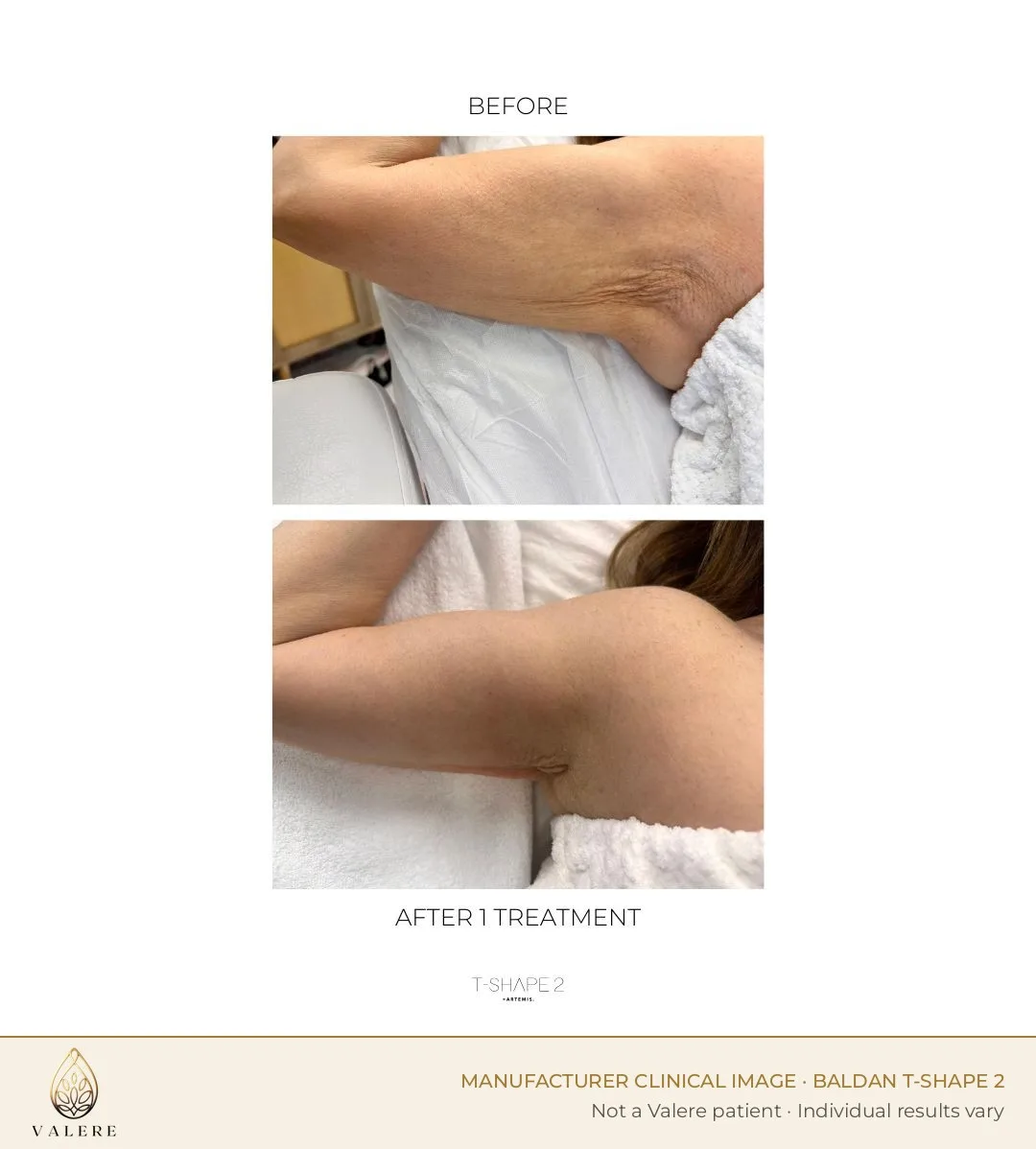 T-Shape 2 before and after, upper arm, one treatment