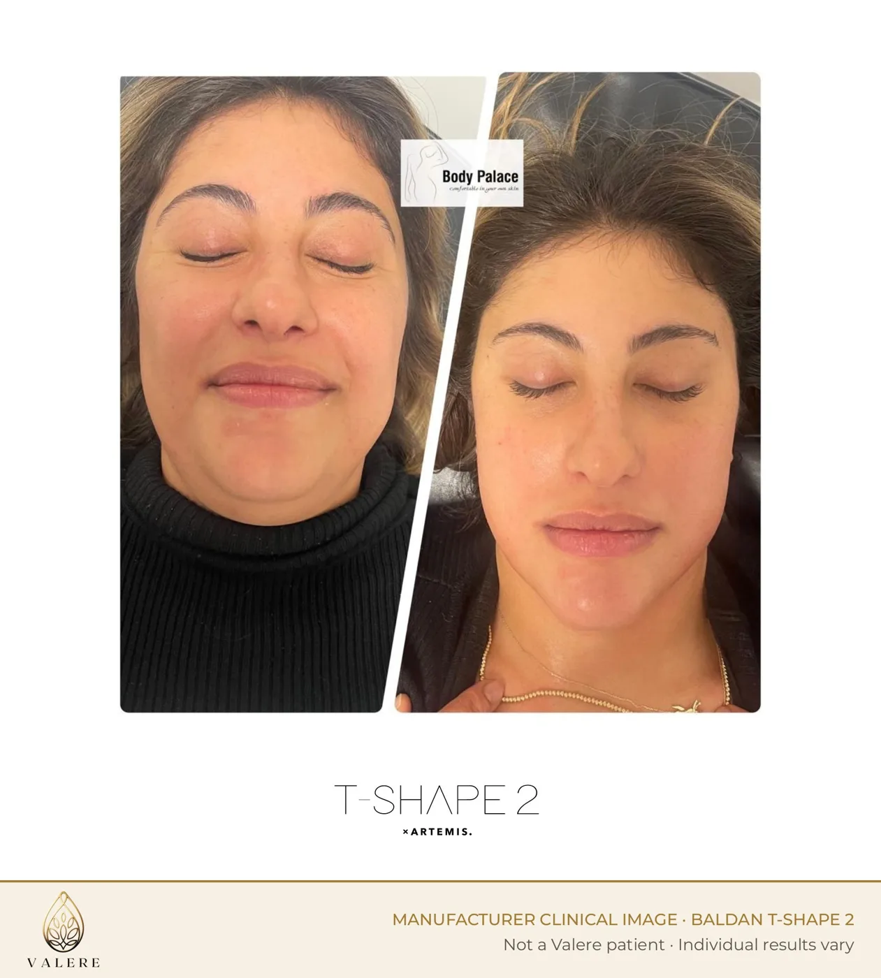 T-Shape 2 before and after, face
