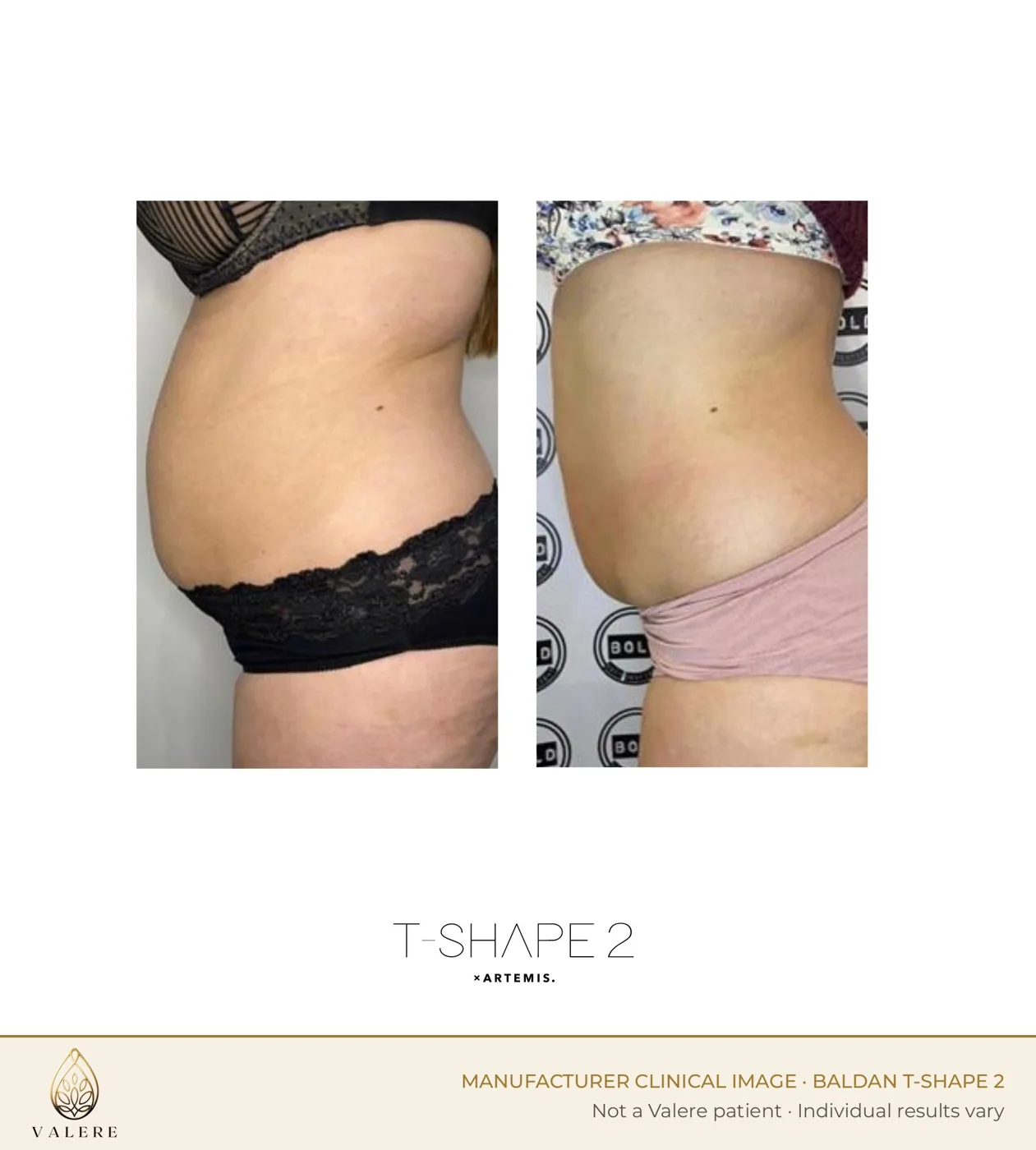 T-Shape 2 before and after, waist and flank, side view