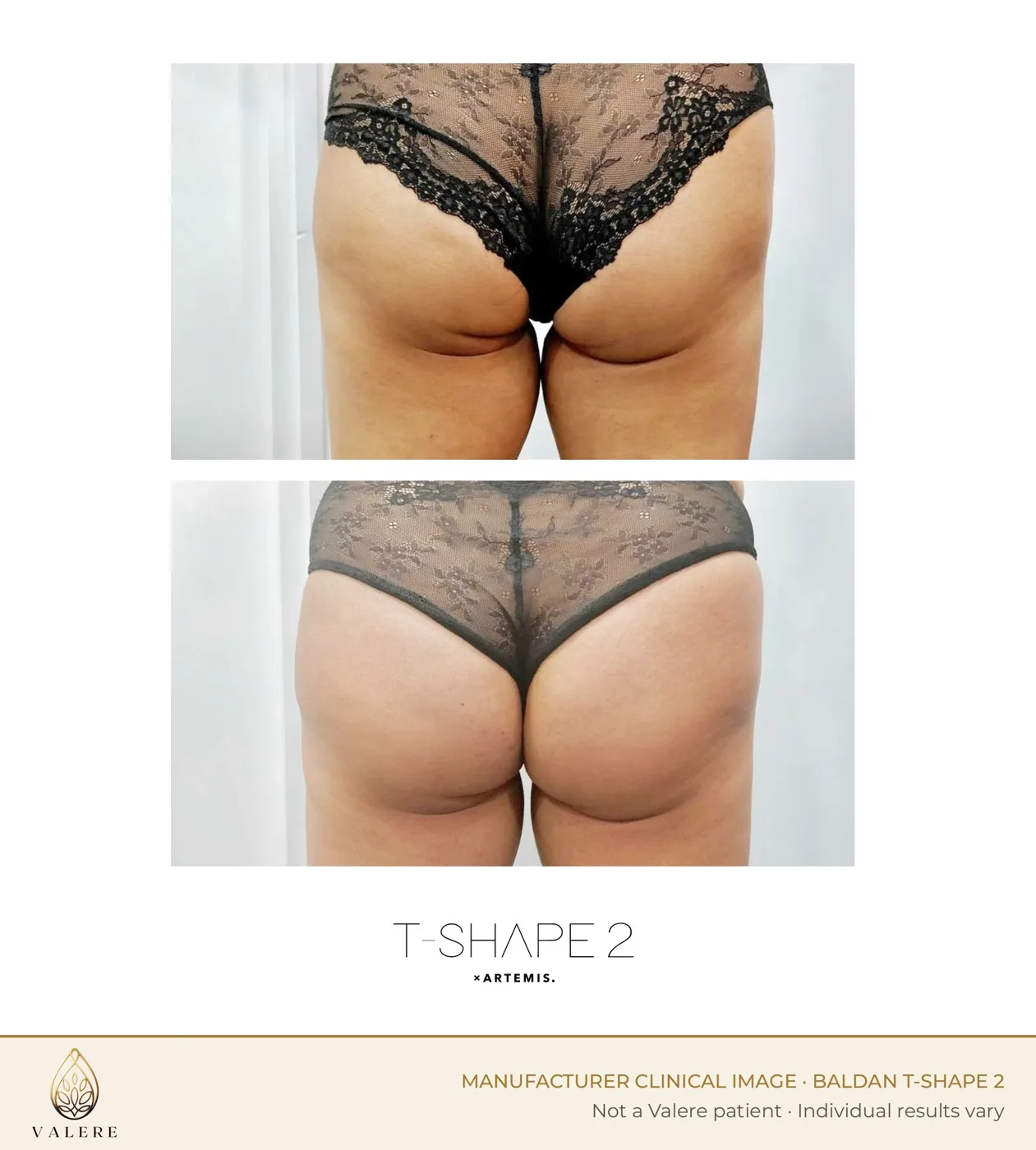 T-Shape 2 before and after, glutes, cellulite appearance