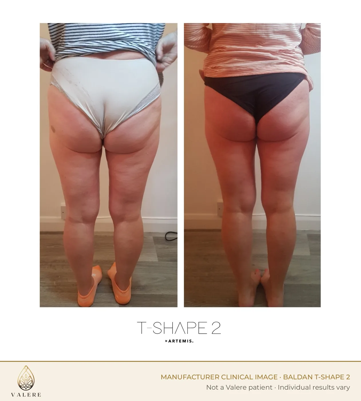 T-Shape 2 before and after, back of thighs, cellulite appearance