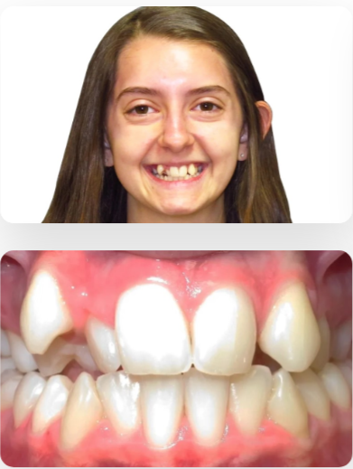 Before and after Invisalign treatment in Frisco