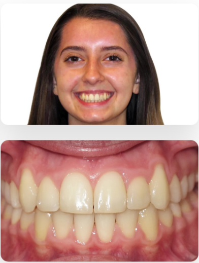 Before and after Invisalign treatment in Frisco