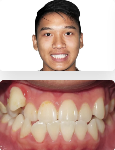 Before and after Invisalign treatment in Frisco