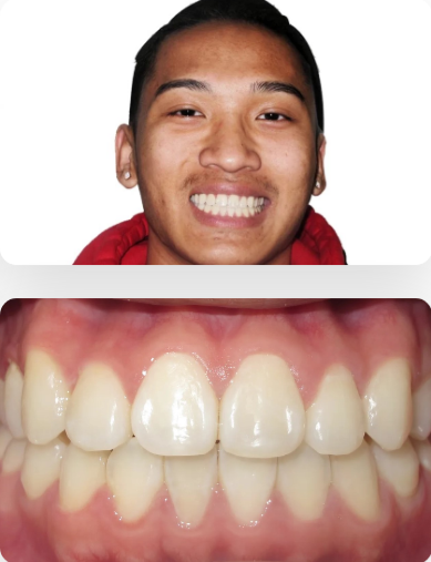 Before and after Invisalign treatment in Frisco