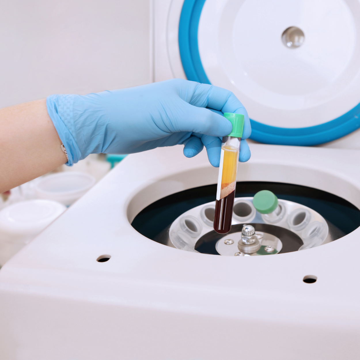 Platelet-rich plasma used with medical microneedling for the Vampire Facial