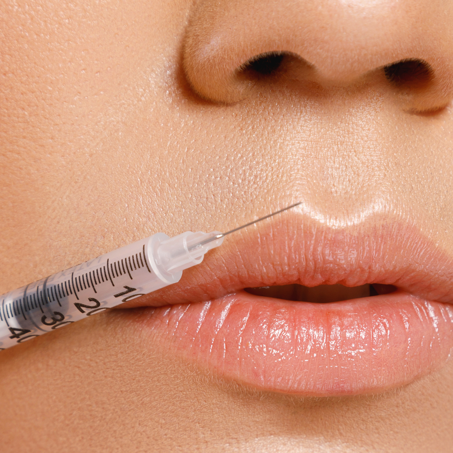Individualized facial balancing with dermal filler