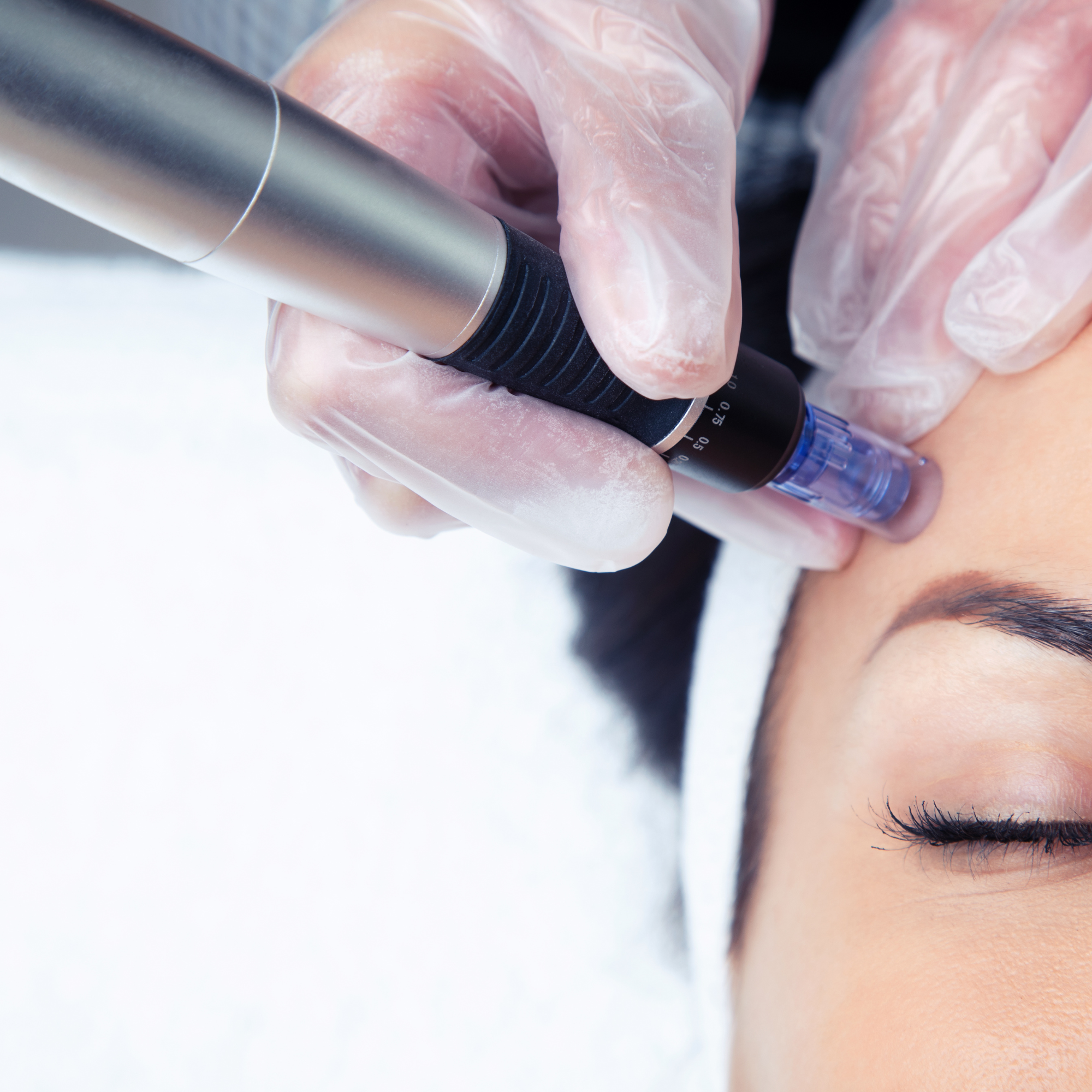 Vampire Facial regenerative microneedling treatment at Aesthetics by the Institute