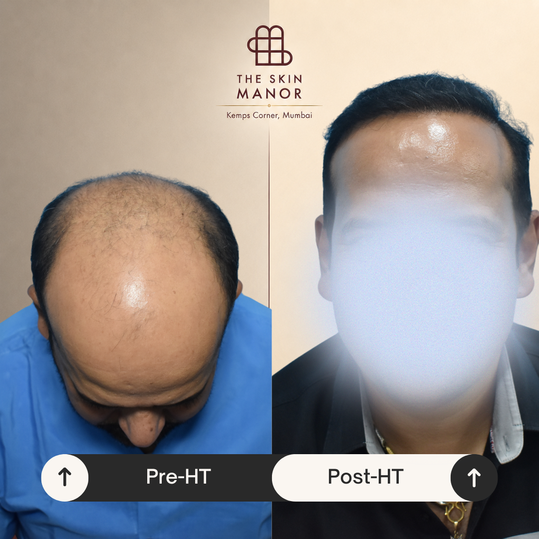 Hair transplant before and after
