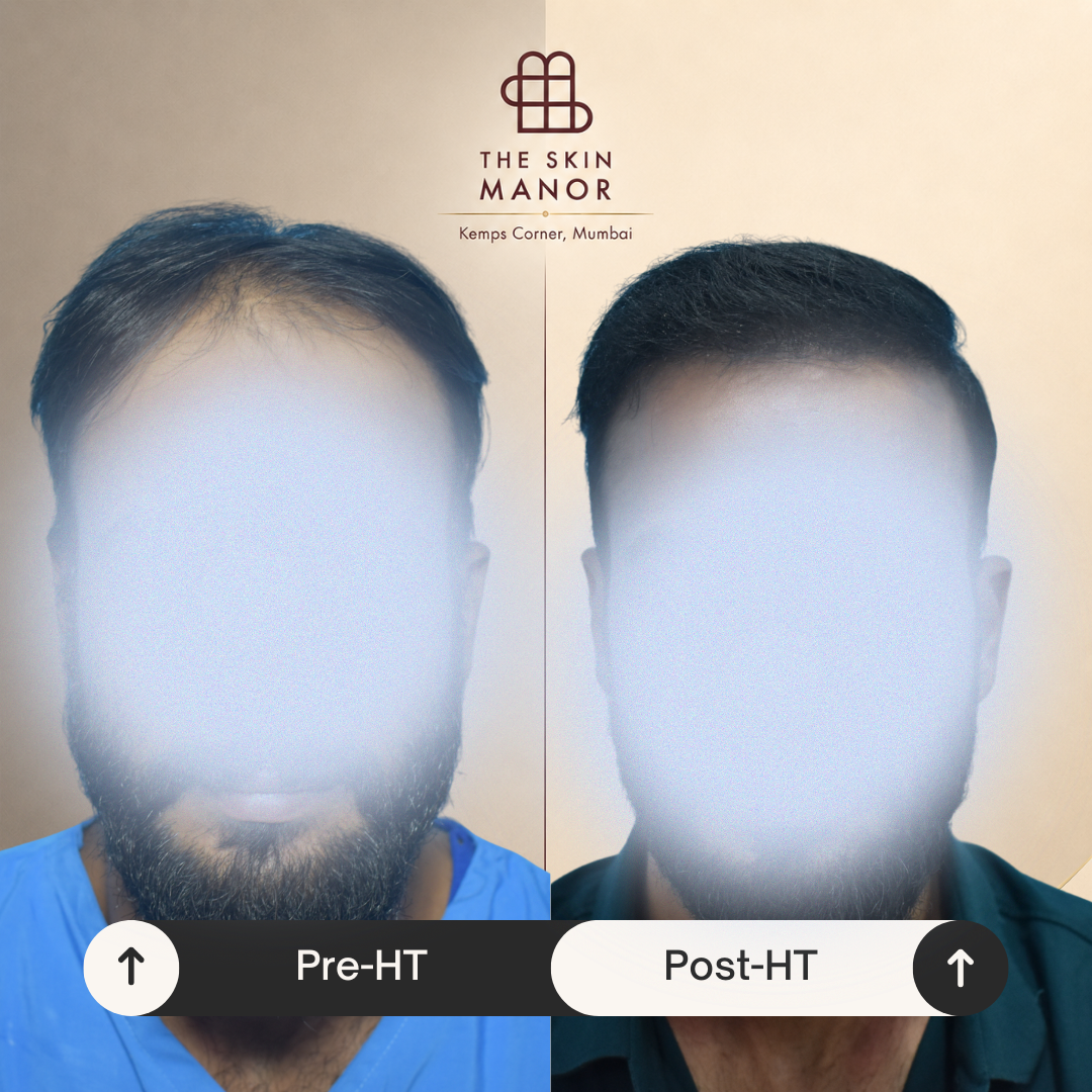 Hair transplant before and after at The Skin Manor
