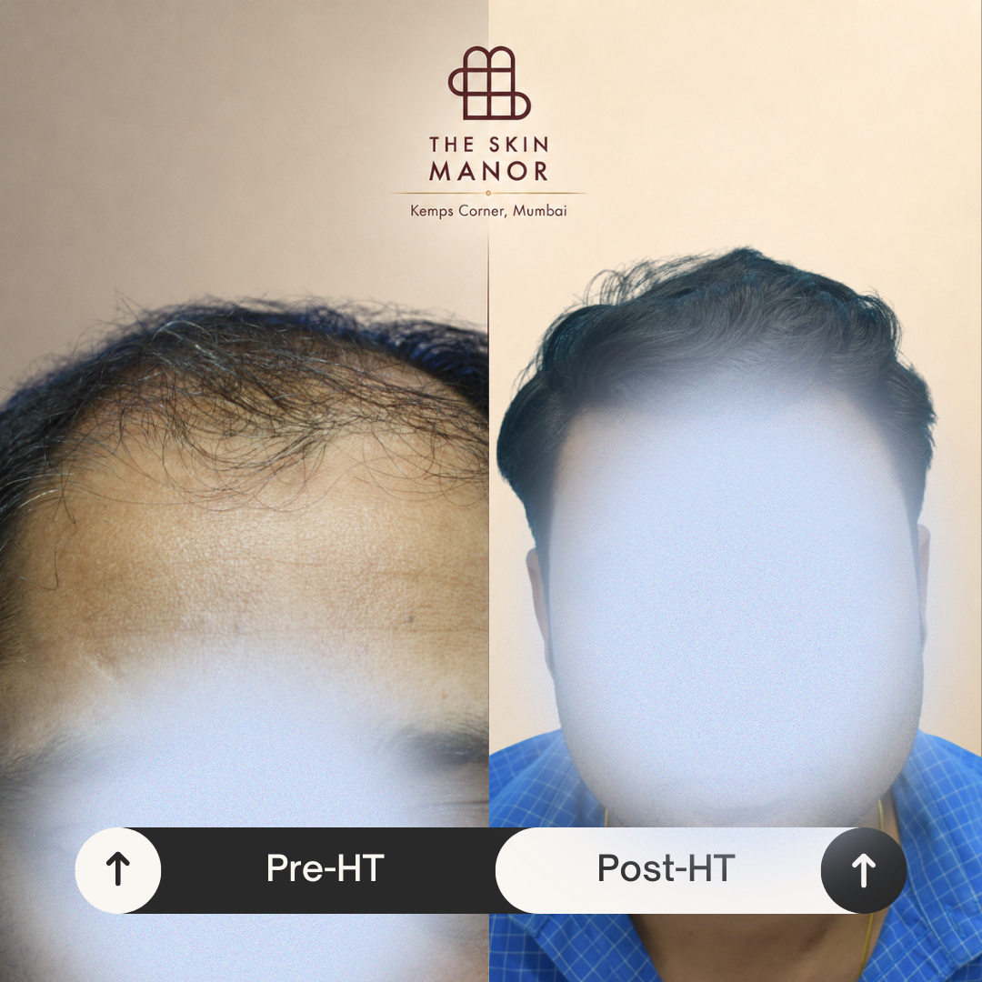 Hair transplant before and after