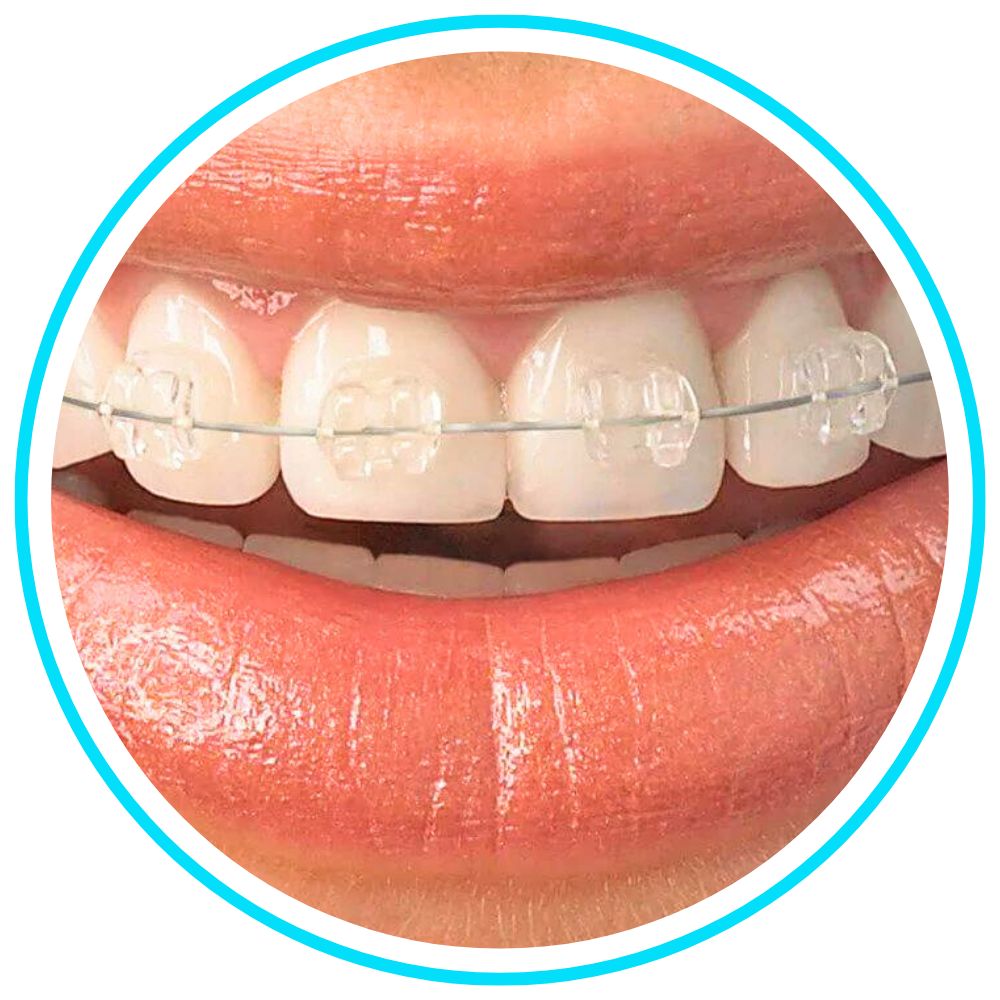 Invisalign Clear Aligners - Castle Valley Orthodontics