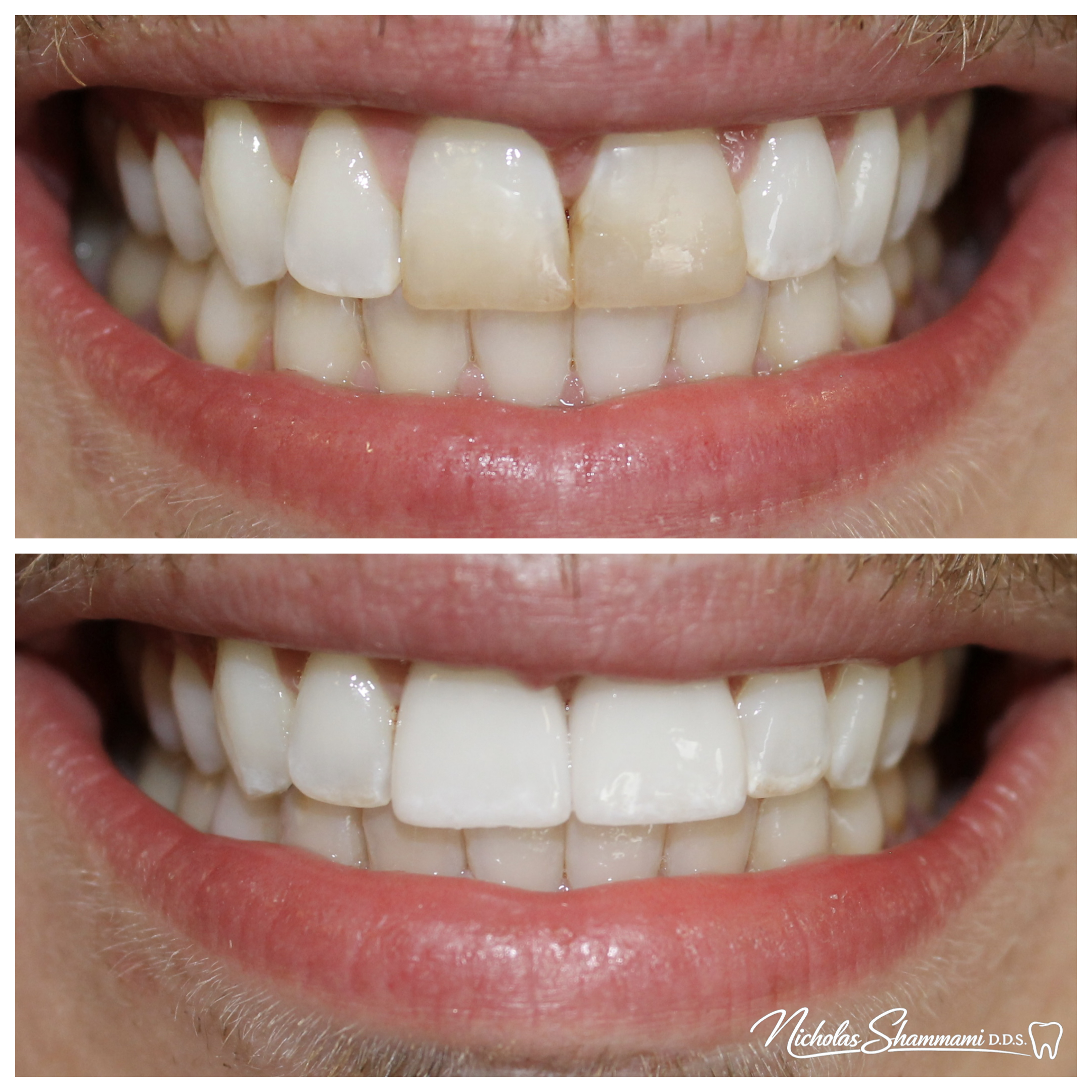 Two Veneers Replacing Old Stained Bonding - Before and After by Nicholas Shammami, DDS
