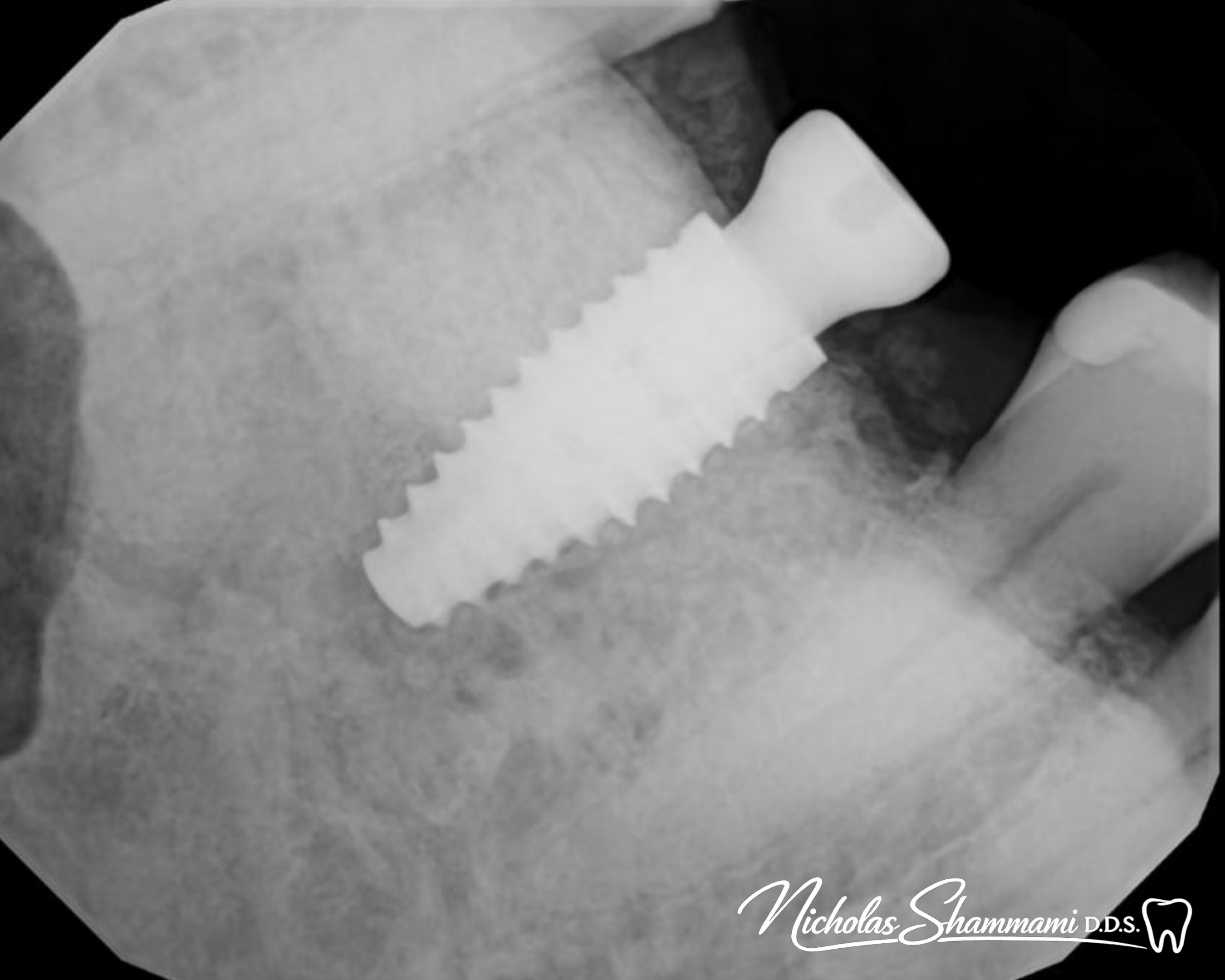 Molar Implant for a Strong Foundation - Before and After by Nicholas Shammami, DDS