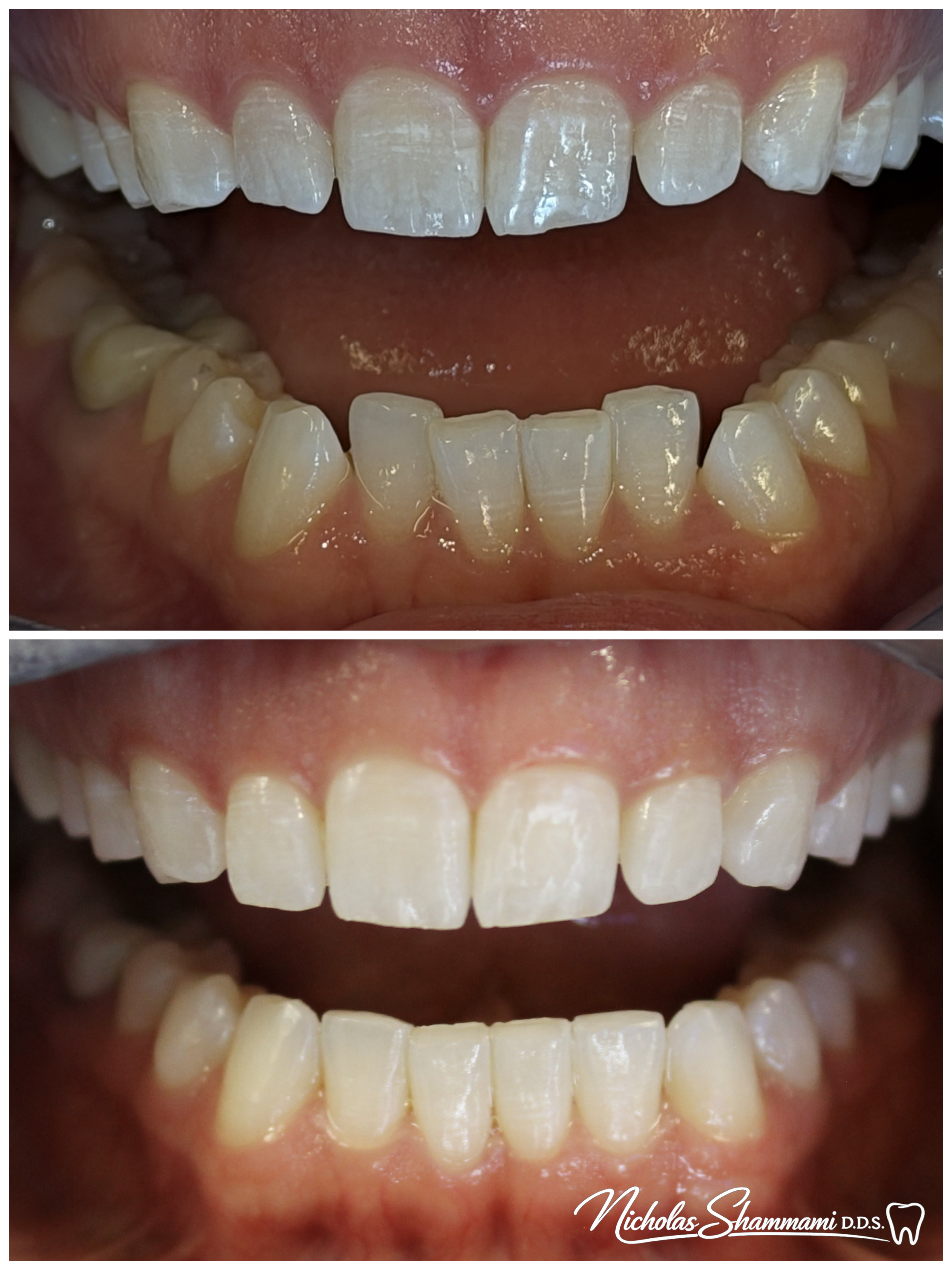 Invisalign to Straighten Lower Front Teeth - Before and After by Nicholas Shammami, DDS