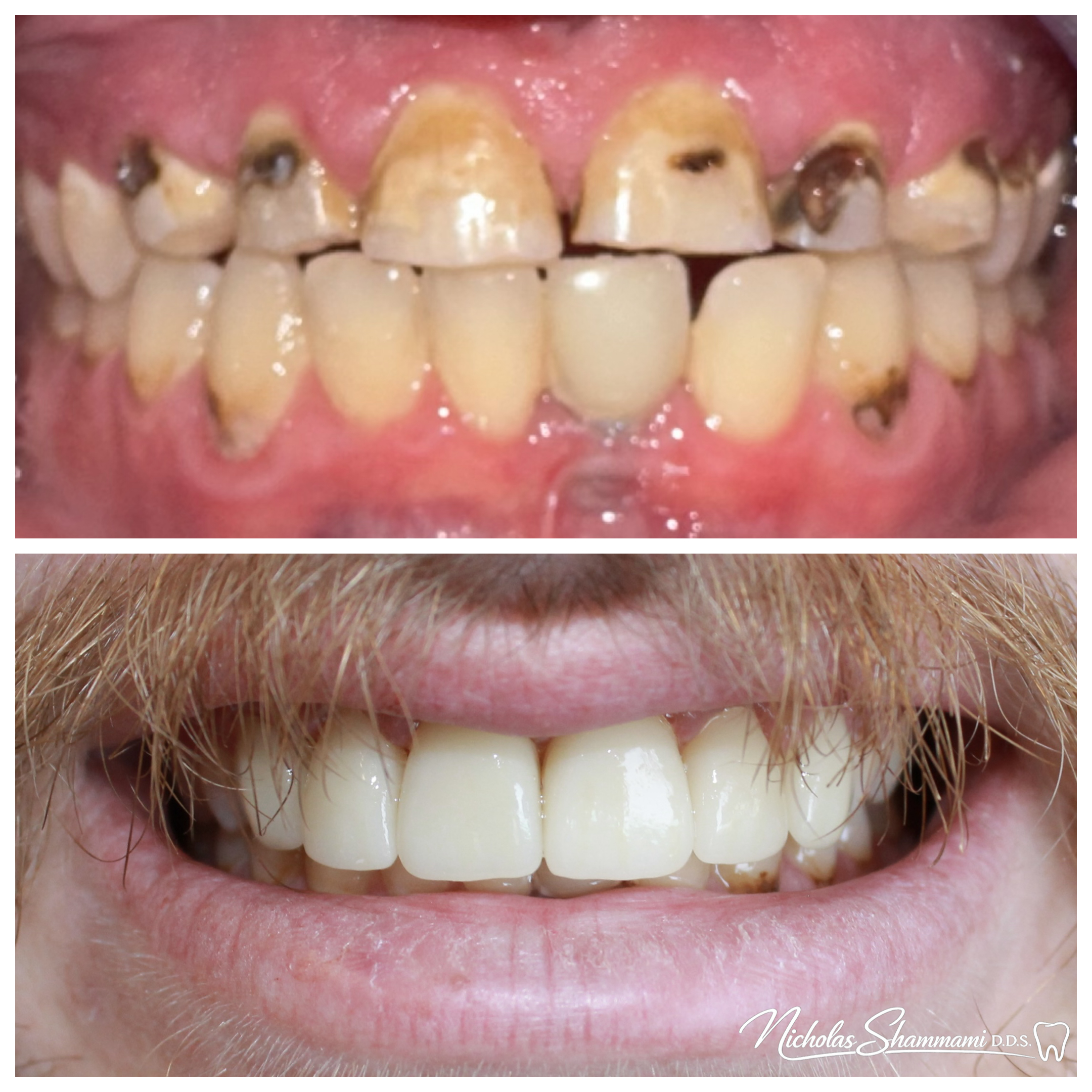 Smile Restoration with Six Dental Crowns - Before and After by Nicholas Shammami, DDS