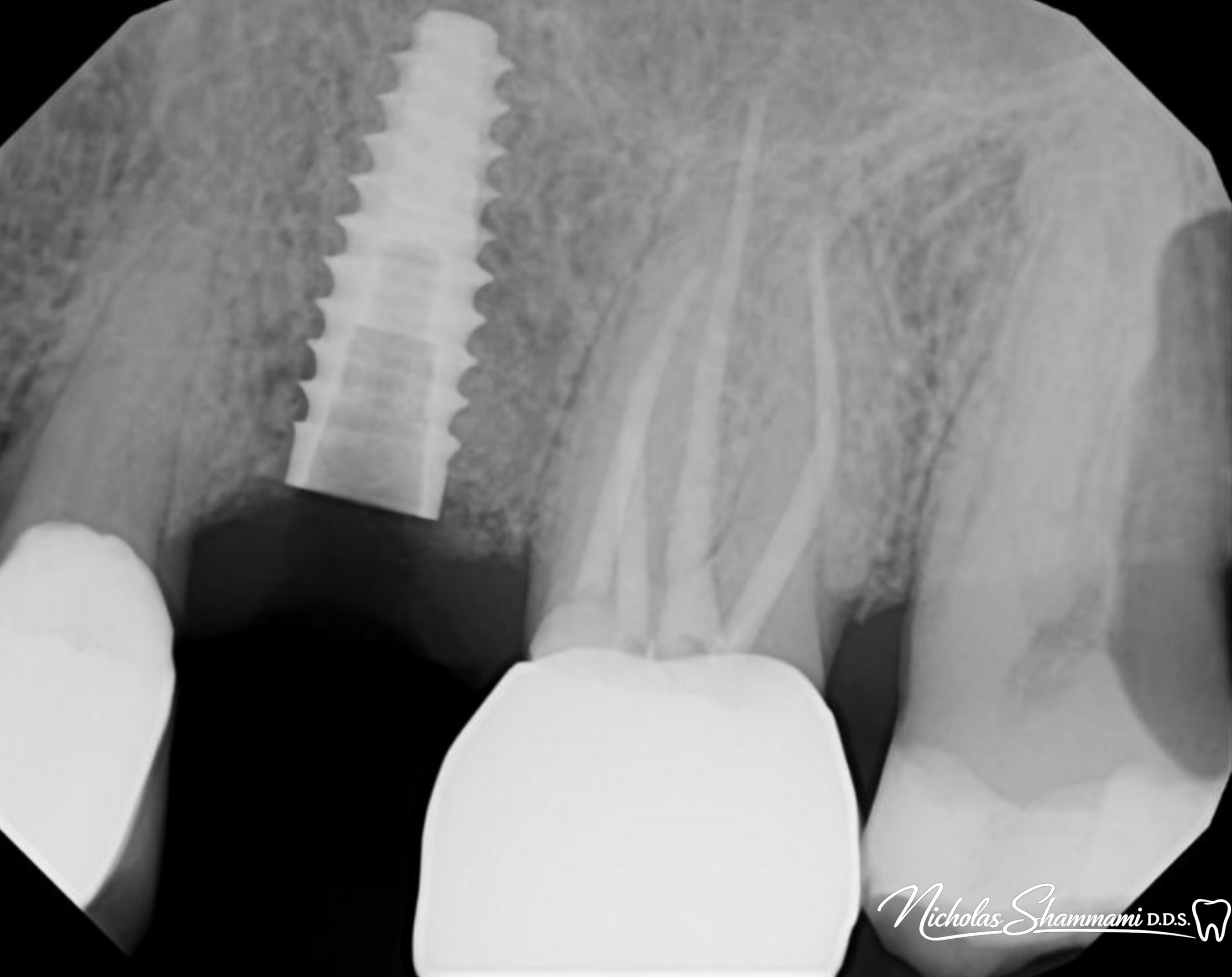 Implant Restoration - Before and After by Nicholas Shammami, DDS