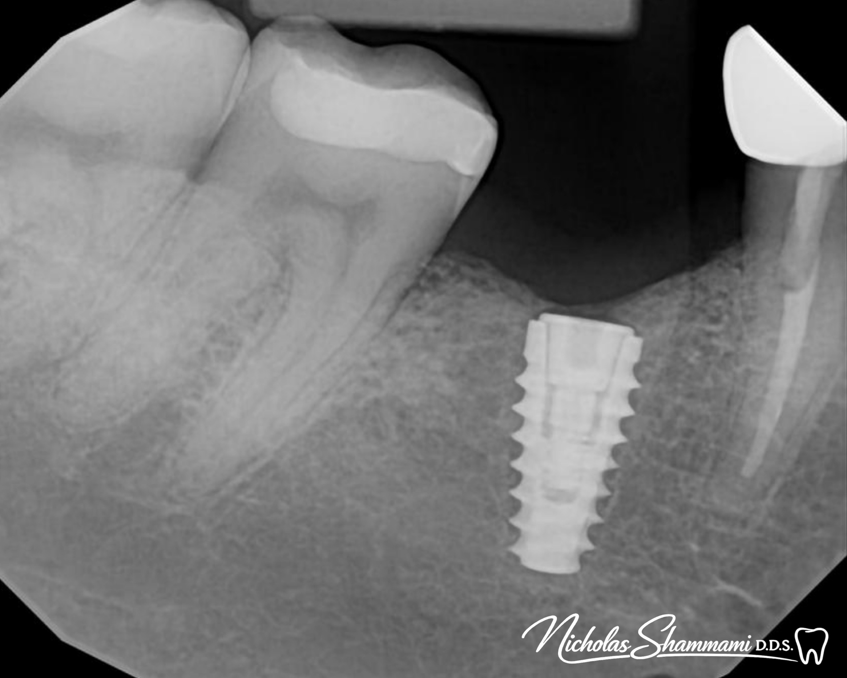 Molar Implant to Restore Proper Function - Before and After by Nicholas Shammami, DDS