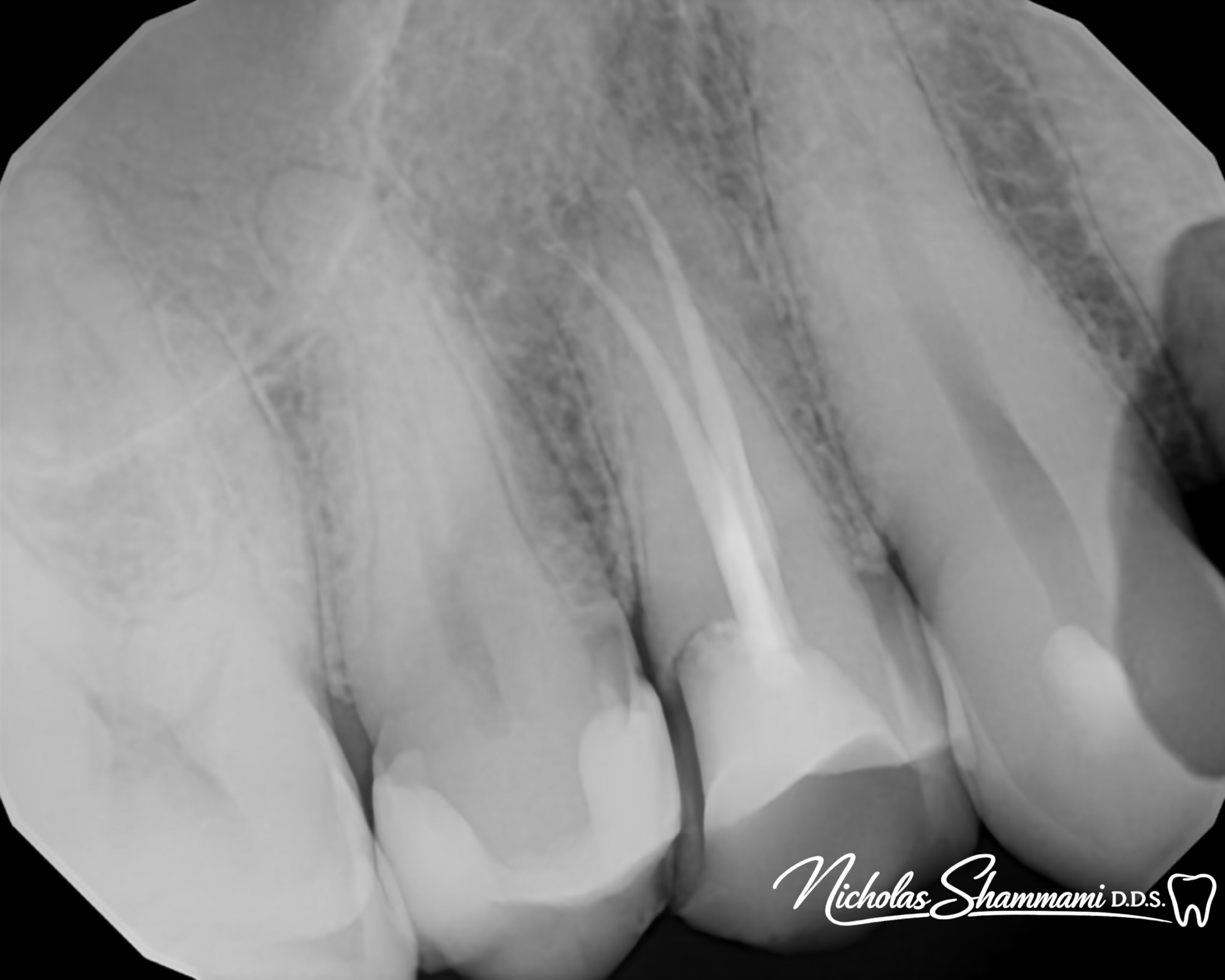Same-Day Root Canal for Emergency Pain Relief - Before and After by Nicholas Shammami, DDS