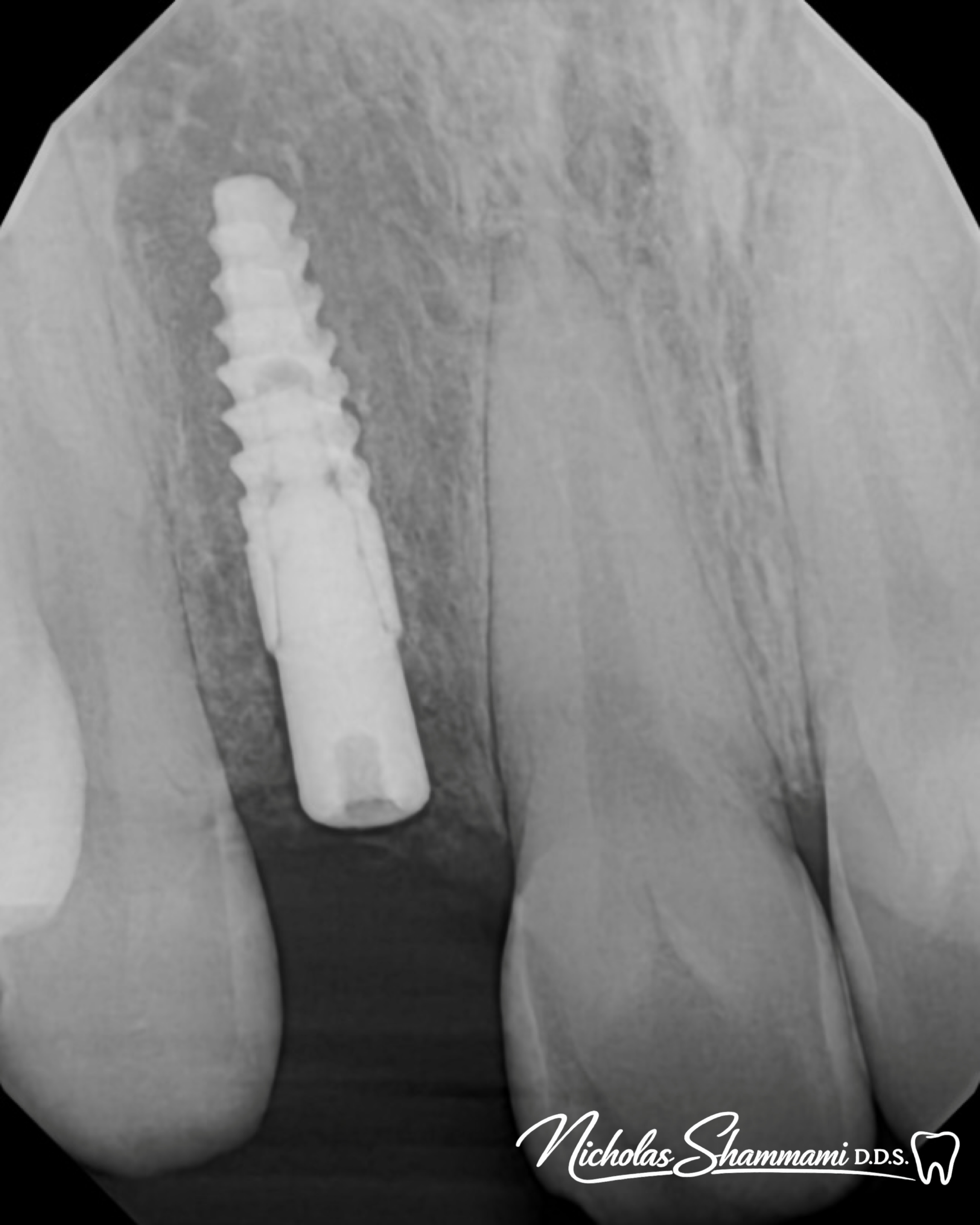 Implant to Restore a Missing Front Tooth - Before and After by Nicholas Shammami, DDS