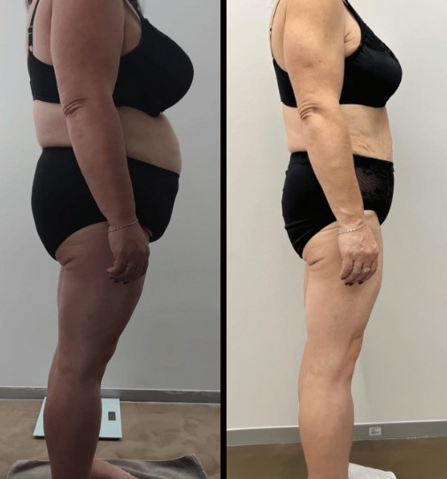 Emerald Laser before and after results