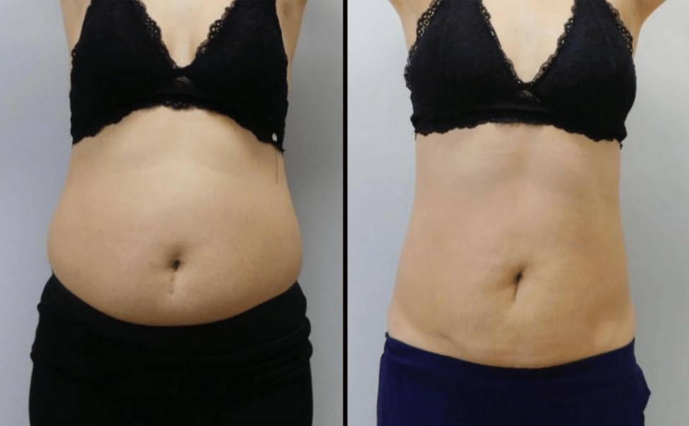 Emerald Laser before and after results
