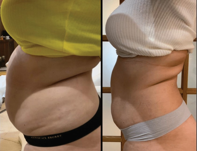 Emerald Laser before and after results