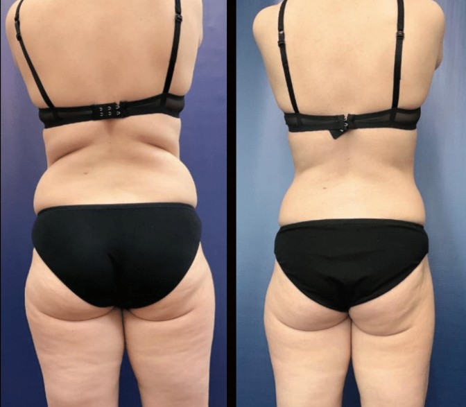 Emerald Laser before and after results