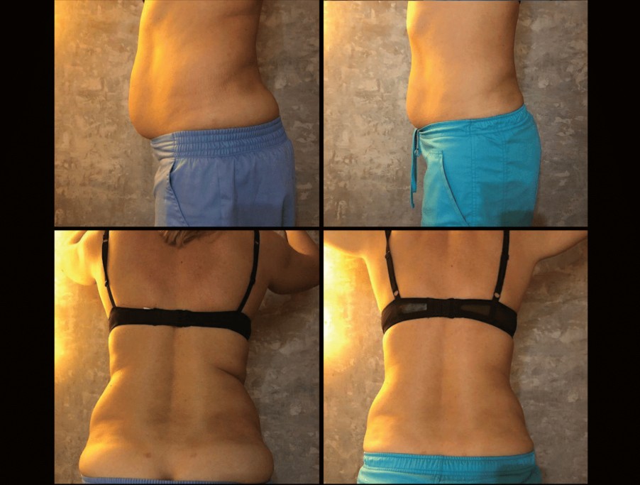 Emerald Laser before and after results