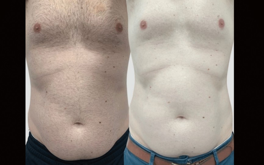 Emerald Laser before and after results