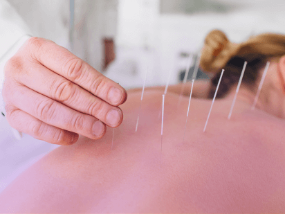 Acupuncture