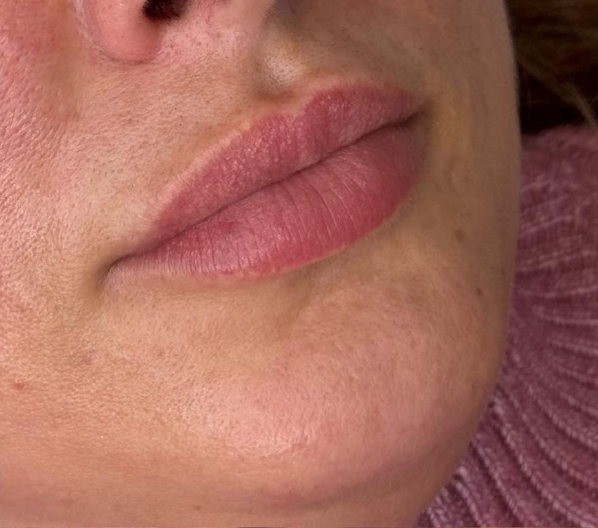 Prima – Rinofiller e profilo armonizzato