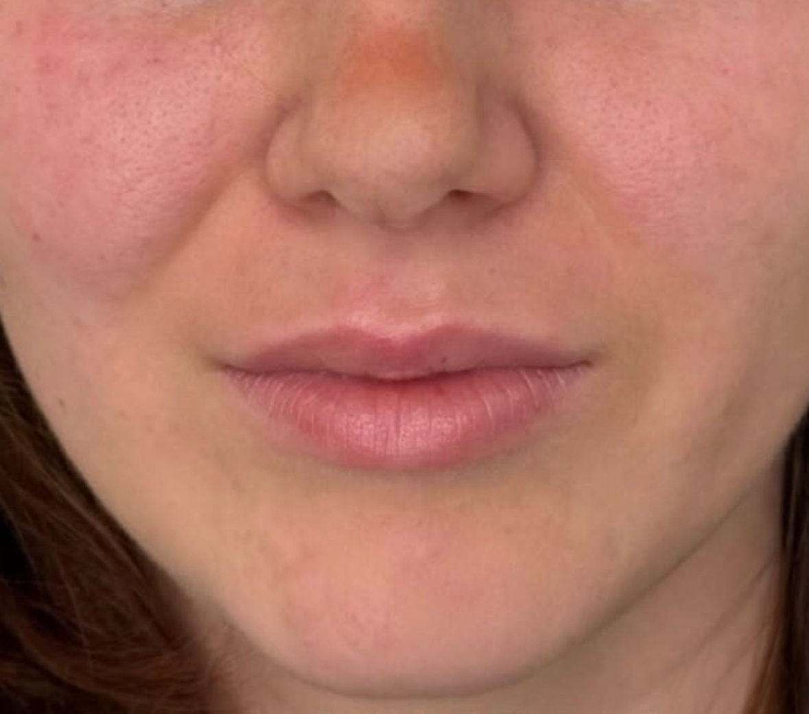 Prima – Ricostruzione volumi zigomatici