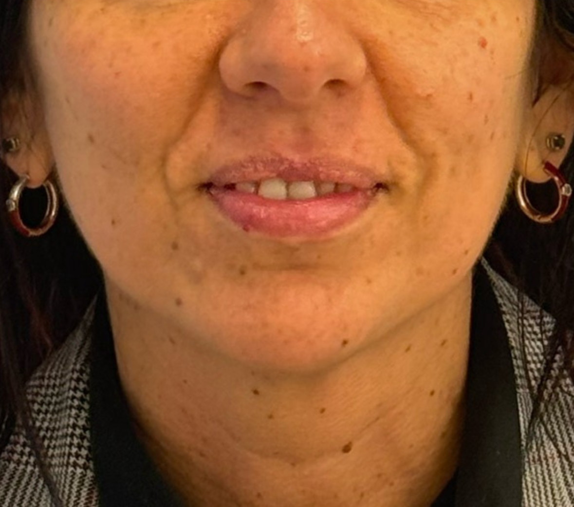 Prima – Armonizzazione mento e labbra