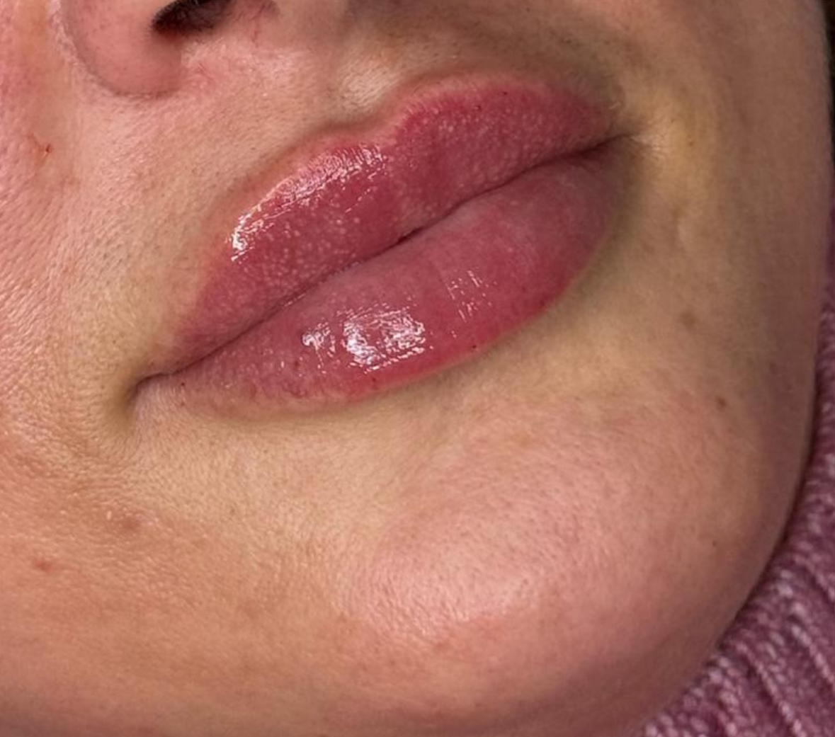 Dopo – Rinofiller e profilo armonizzato