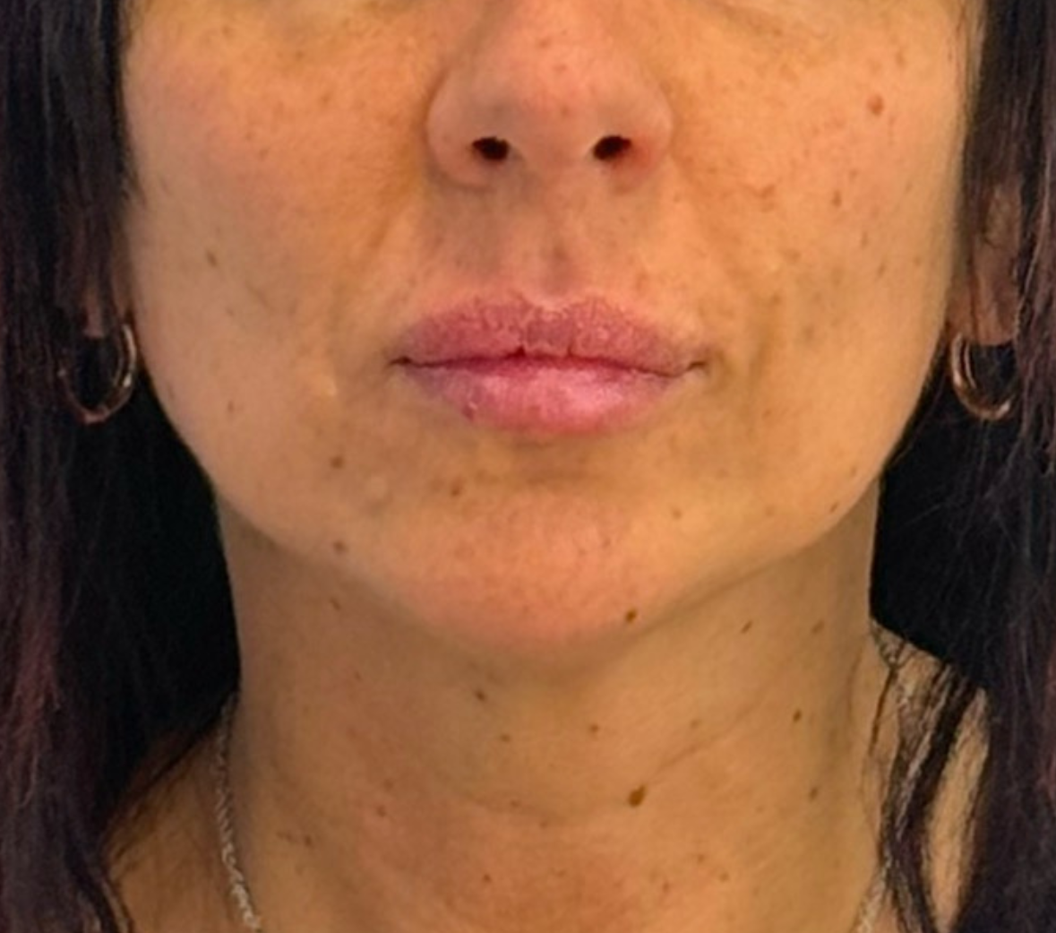 Dopo – Armonizzazione mento e labbra