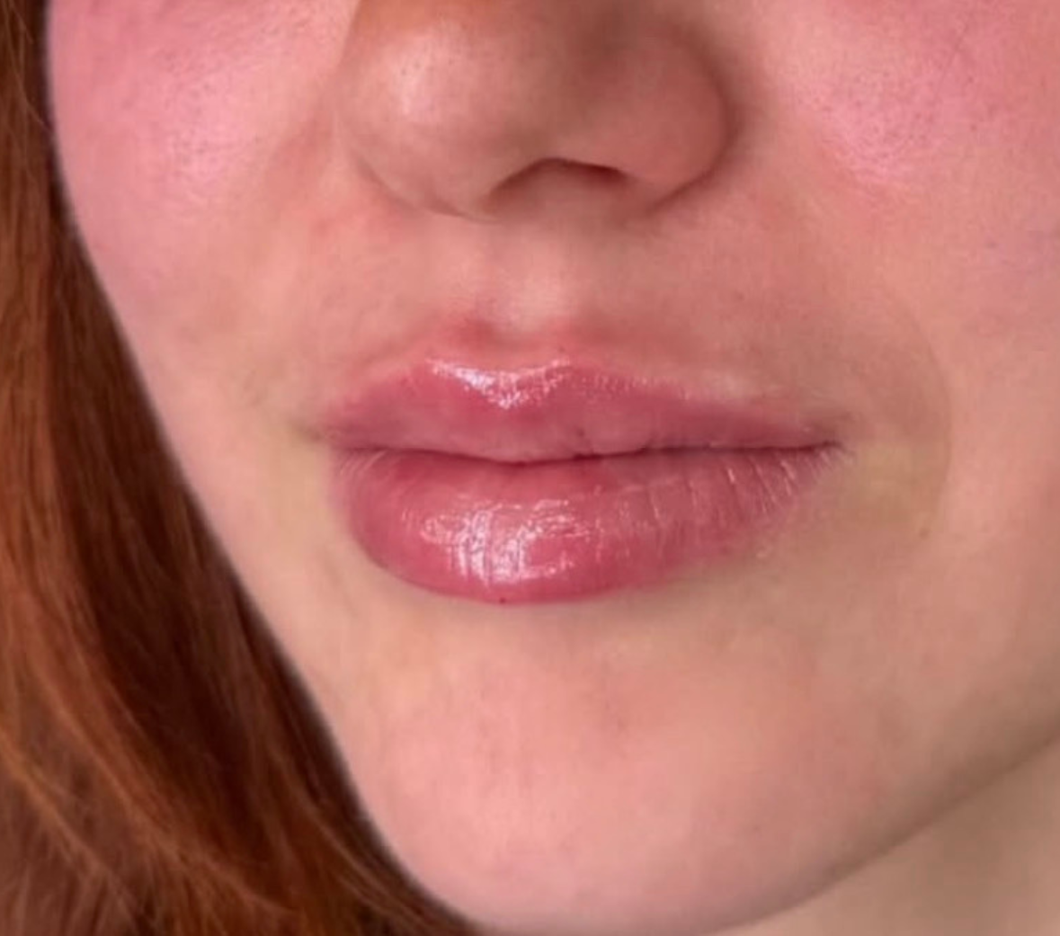 Dopo – Ricostruzione volumi zigomatici