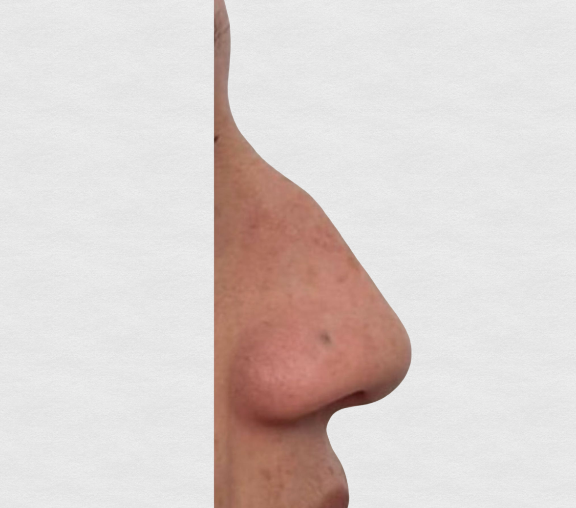 Prima – Botox terzo superiore