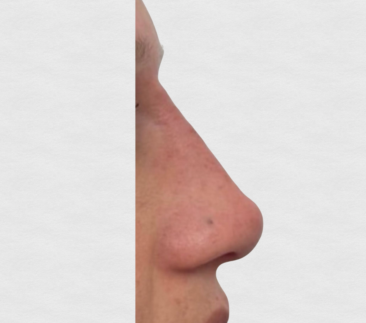 Dopo – Botox terzo superiore