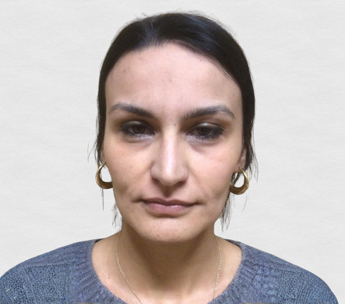 Prima – Tossina botulinica terzo superiore