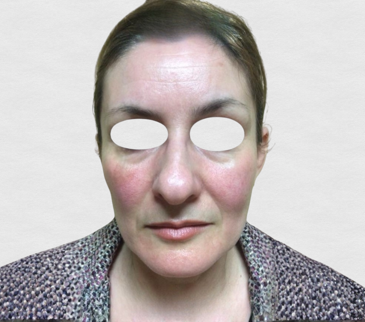 Prima – Rughe glabella e fronte