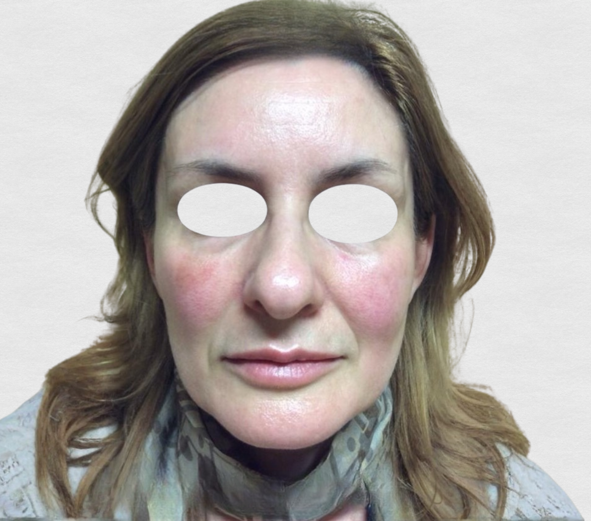 Dopo – Rughe glabella e fronte