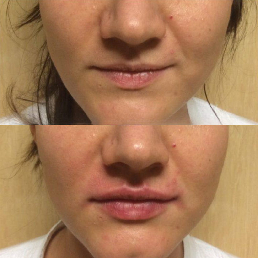 Prima e dopo – trattamento con tossina botulinica