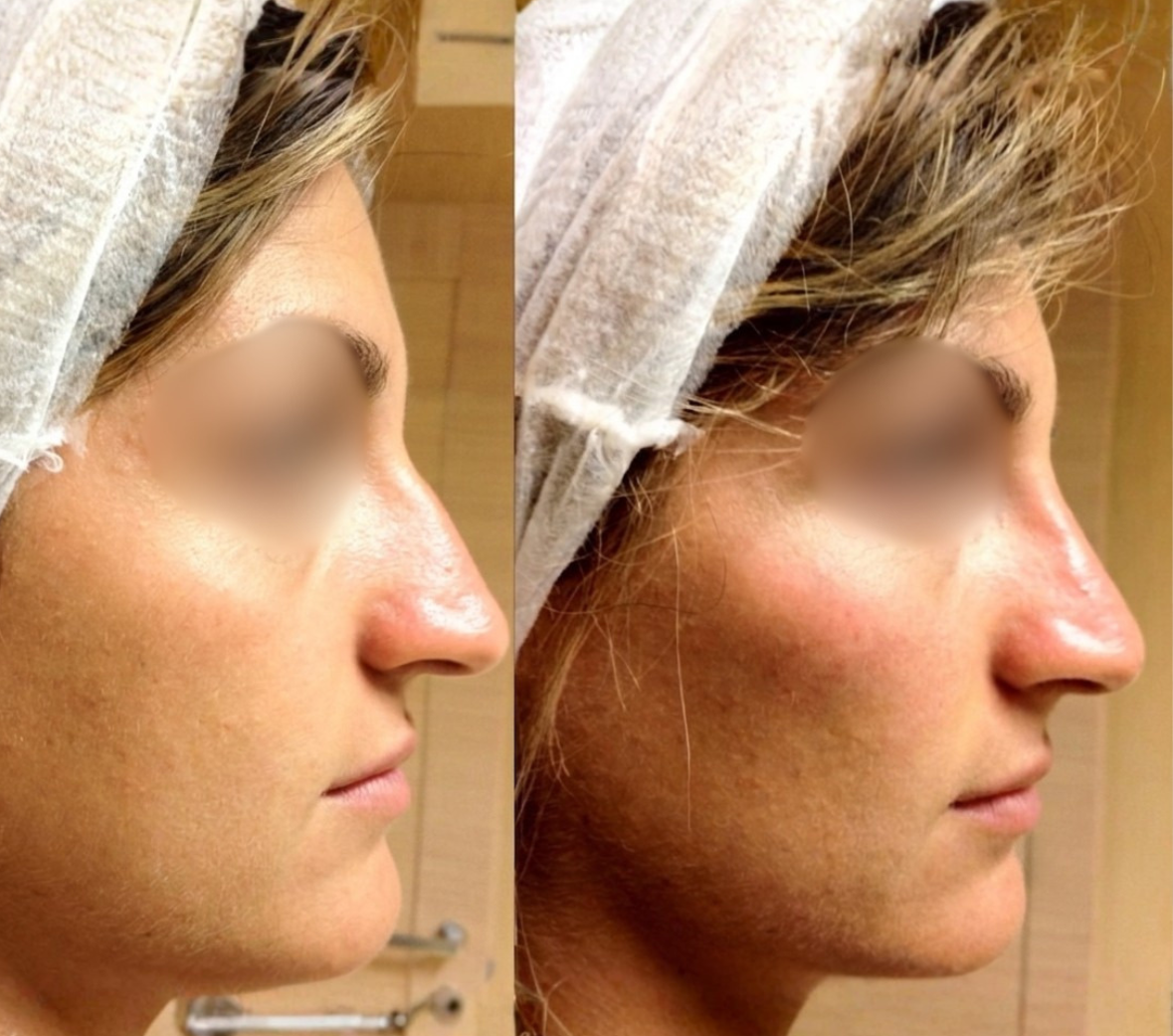 Prima e dopo – trattamento con tossina botulinica