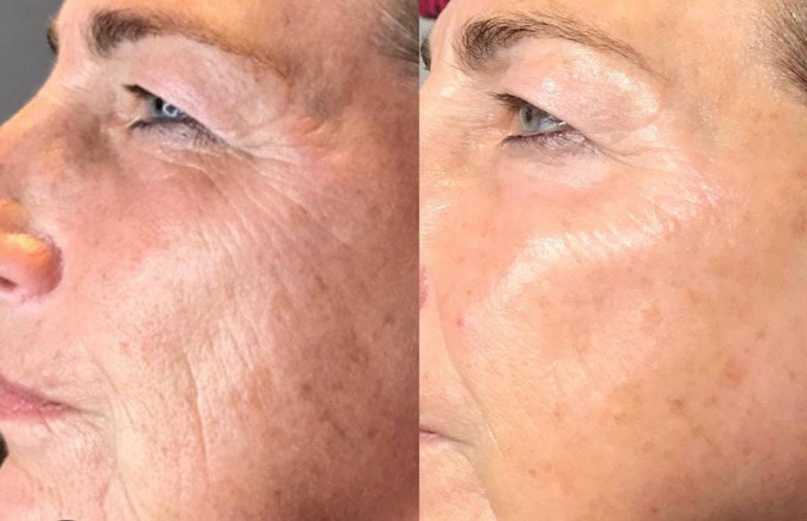 Esthetician using a microcurrent device during an anti-aging facial