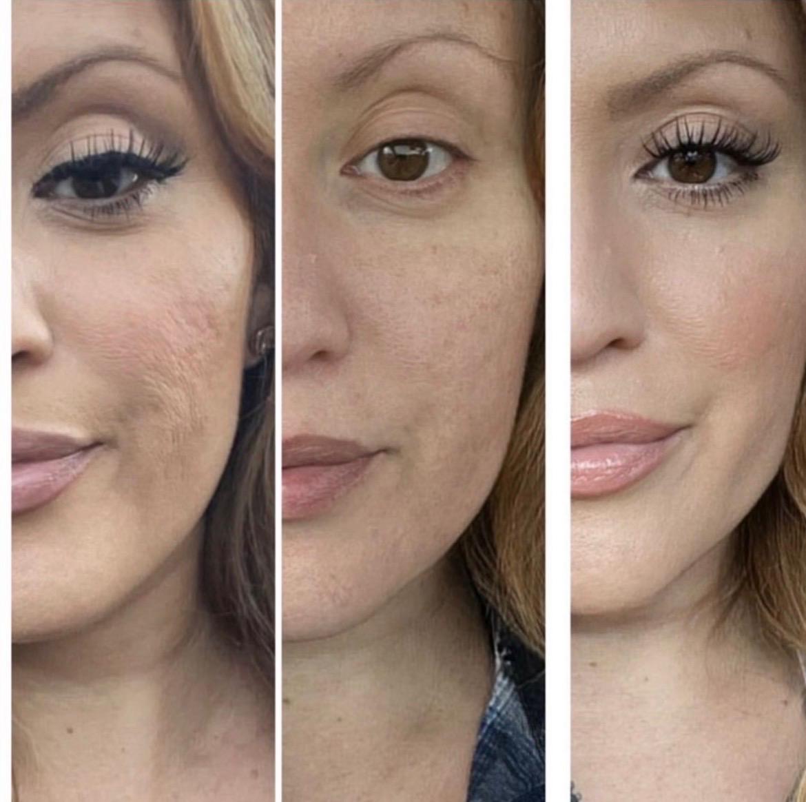 Esthetician performing a microneedling treatment in Van Nuys