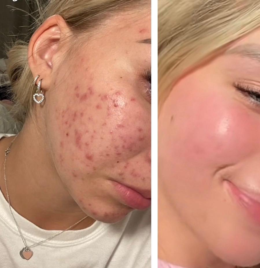Esthetician using a high-frequency wand during an acne facial