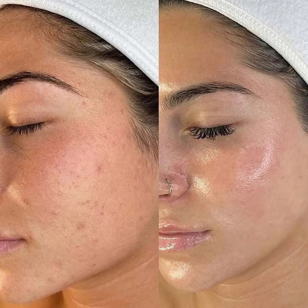 Morpheus8 Results - Neck and Jawline
